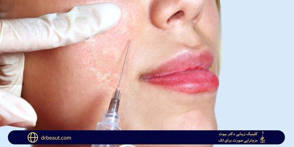 mesotherapy-for-blemishes