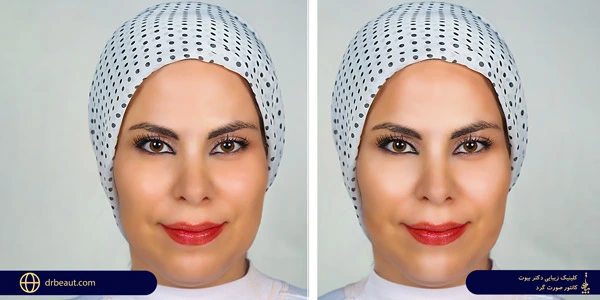 Round-face-contour