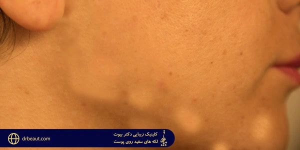 White-spots-on-the-skin
