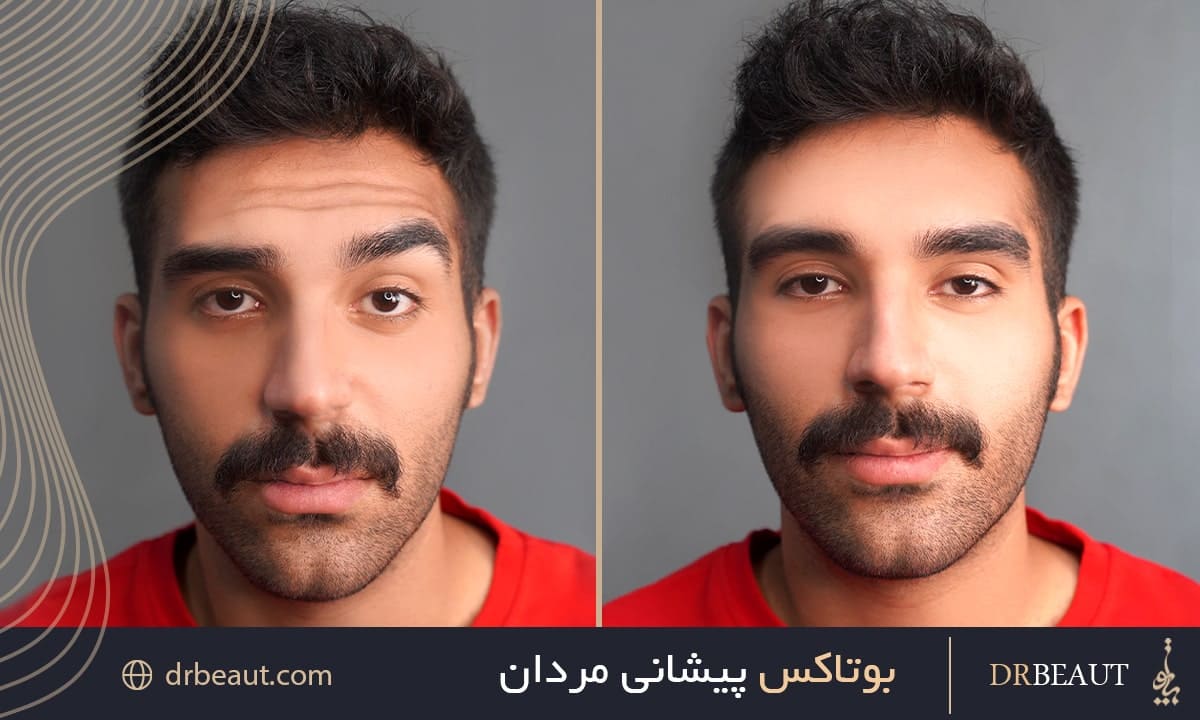 بوتاکس پیشانی مردان