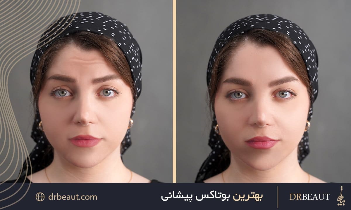 بهترین بوتاکس پیشانی