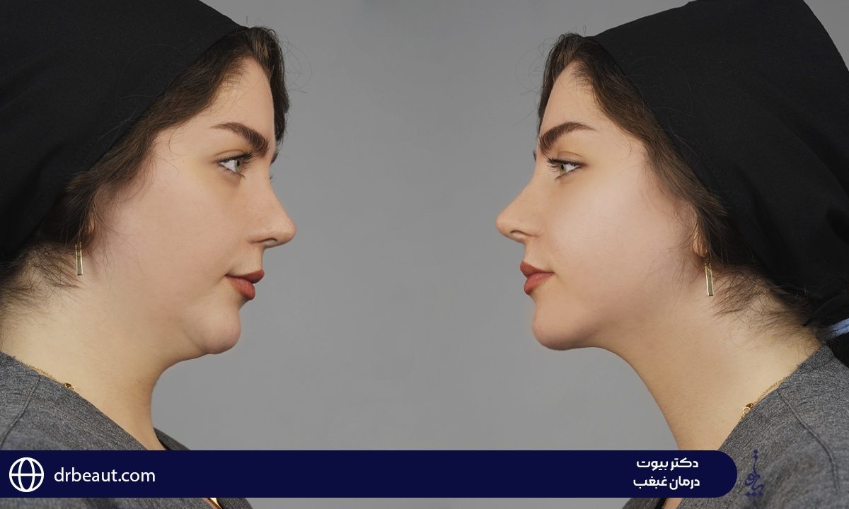 بهترین روش‌های درمان غبغب بدون جراحی